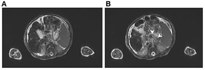 Efficacy of Intravenous Immunoglobulin/Exchange Transfusion Therapy on Gestational Alloimmune Liver Disease